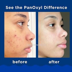 #9: PanOxyl acne creamy 