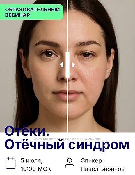 Павел Баранов Отёки. Отёчный синдром 2025